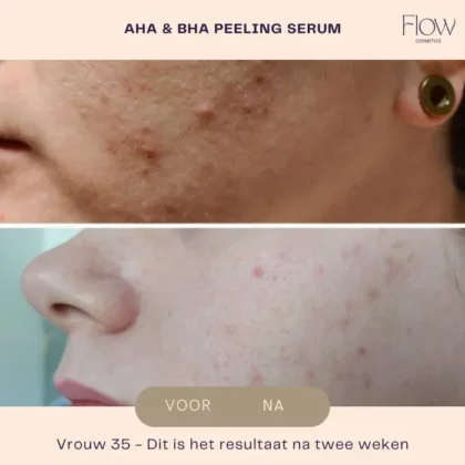 AHA & BHA peeling results