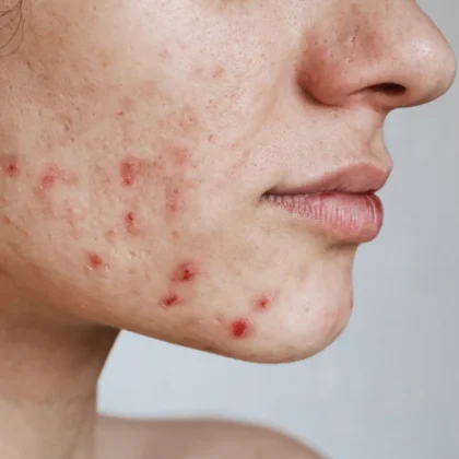 Acne Skincare