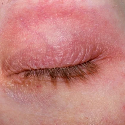 Atopische huid