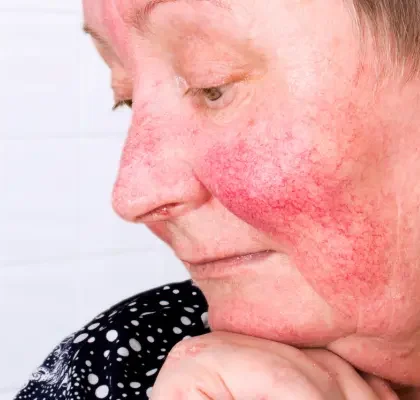 Rosacea Skincare